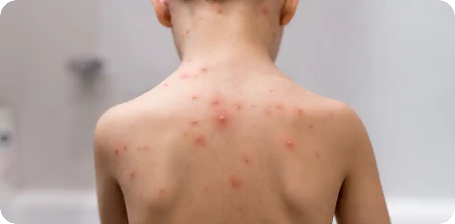 Varicela en niños