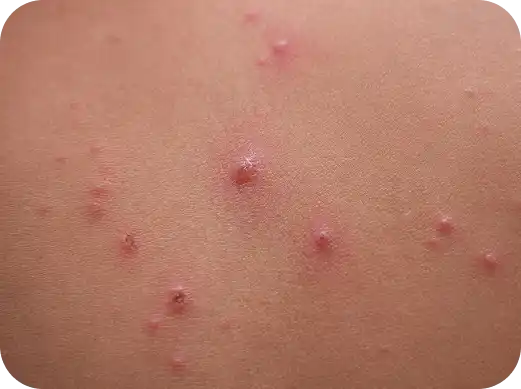 &iquest;C&oacute;mo saber si tienes varicela?